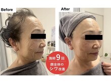 リュクシー(LuxeY)の雰囲気（高濃度幹細胞エクソソームでしみくすみしわたるみケア本町/小顔/）