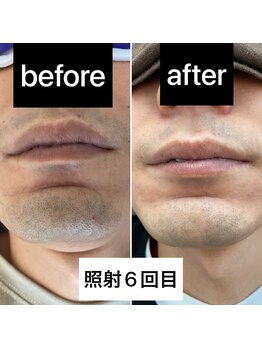 ラウラウ(laulau)/メンズヒゲ脱毛