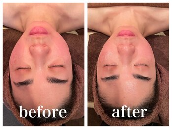 ハリキュア(H.a.r.i C.u.r.e.)/美容鍼、フェイシャル