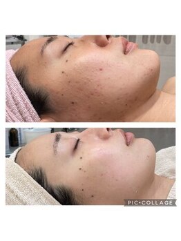 クリスタル(CRYSTAL)/光フェイシャル