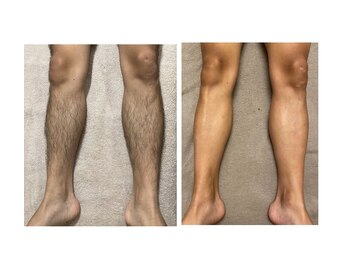 ラナンス 千早(LANUNCE)/足脱毛