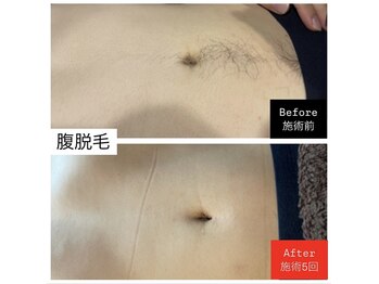 ヴァリエ(Varier)/BeforeAfter