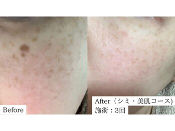 アレイズ(ARAYS)/症例