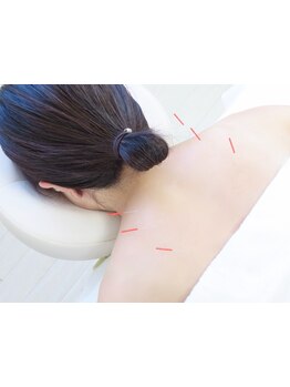 鍼灸施術を受けたい