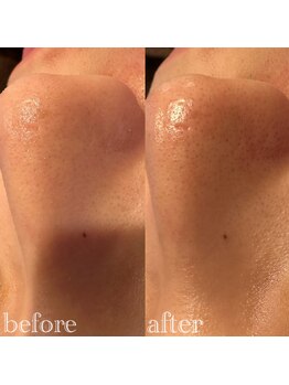 ラベンディア アザブ(LAVENDIA Azabu)/毛穴洗浄