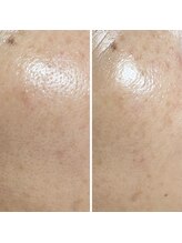 晴(haru)/毛穴こそホームケア×サロンケア