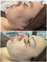 ミラヴィエ(Miravie)/1年かけて別人級のツヤ肌に