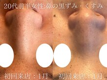 ブリエ(Briller)/毛穴洗浄＋幹細胞トリートメント