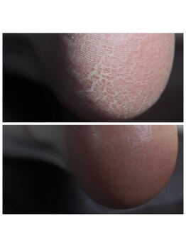 キコ ネイル(KICO nail)の写真/”頑固なかかと” 夏までにどうにかしませんか?【ベベケアスパ】スタートいたしました!