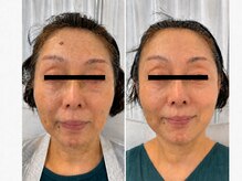整顔院 学芸大学店/６０代　継続期間３ヶ月　