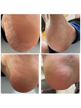 ソート(THOUGHT)/かかと角質ケア