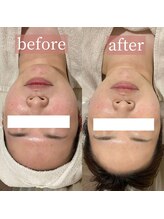 アディクトウラ(Addict'ula)/ウルトラ小顔マッサージ