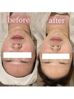 アディクトウラ(Addict'ula)/ウルトラ小顔マッサージ