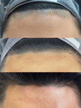 シーケスト(seekest.)/額の脱毛