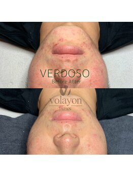 ジュエッテ(jouete)/volayon