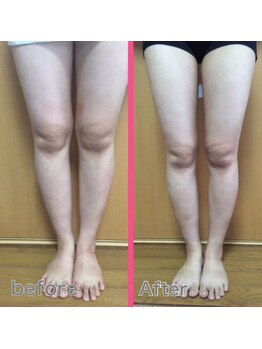 セルビューティー(Cell Beauty)/30代、筋膜リリース下半身20回