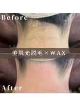 エピナ 横浜店(Epina)/うなじMIX脱毛☆