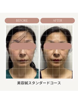 サロン ド ハリッシュ(Salon de HARISH)/3回目の施術後