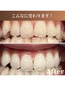 【透明感抜群！健康的な白い歯に！】一度で効果実感！セルフホワイトニング 