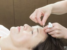鍼灸チェリーハンド