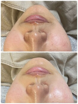 ニコリ(Nicori)/シェービングフルエステ