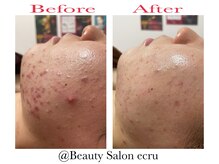 エクリュ(ecru)の雰囲気（ニキビケア専門店だからこそ肌状態に合わせた安心ケアを提供♪）