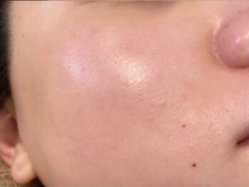 ルウ(Ruu.)の写真/【本気の肌質改善】韓国式ハーブピーリングで憧れの陶器肌へ♪肌トーンUP&毛穴レスなキメ細かさを実感!