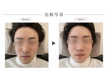 リラボ整体院 赤坂店(RE+LAB=◯整体院)/ビフォーアフター歪み