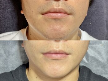 エモーショナル 姫路(Emotional)/ヒゲ脱毛で毎朝が快適♪