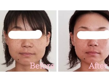 小顔矯正サロン ブルーム/施術3回ビフォーアフター