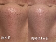 キーオブフェイス(Key of Face)/お悩み【鼻の角栓づまり】