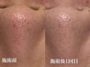 キーオブフェイス(Key of Face)/お悩み【鼻の角栓づまり】