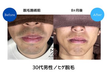 メンズアメリ/高知/メンズ脱毛/ヒゲ/全身/VIO