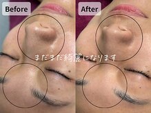 バタフライ 平塚店(Butterfly)/諦めていた毛穴の黒ずみが消える