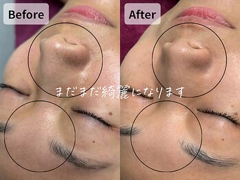 バタフライ 平塚店(Butterfly)/諦めていた毛穴の黒ずみが消える