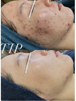 ヒメミ(Himemi)/TIPハーブピーリング