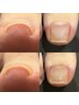 　Hey Switch /ジェルで出来る巻き爪ケア／1本5500円
