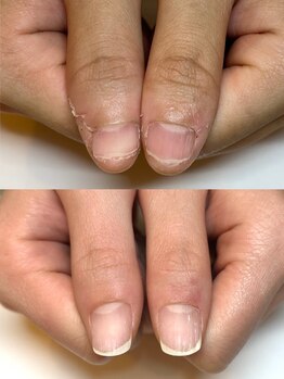 マリーロール 梅田店(Marie Laure)/自爪育成/深爪矯正/ネイルケア