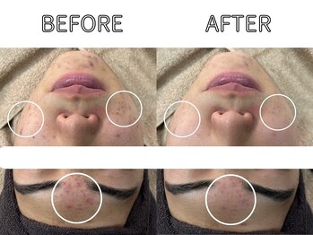 ライム バイ アネラ 高崎(LIME By Anela)/ハーブピーリング/肌質改善