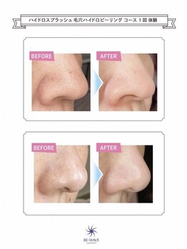 サロンエイトミー 西船橋店(salon 83)/【毛穴ケア】いちご鼻改善