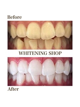 ホワイトニングショップ 銀座7丁目店(WHITENING SHOP)/Before After