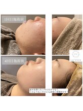 ラヴィオーラ 姫路店(La Viora)/ダイヤモンドハーブピーリング