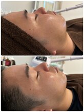 サロン ド グランツィア(salon de Granzia)/20代☆男性☆毛穴ざらつきお悩み