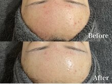 マシェ バイ マユ(Mache by Mayu)/一回の効果が高い！ニキビ鎮静