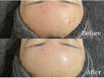 マシェ バイ マユ(Mache by Mayu)/一回の効果が高い！ニキビ鎮静