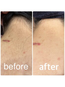 クラスペディア 嘉島店/うなじビフォー・アフター