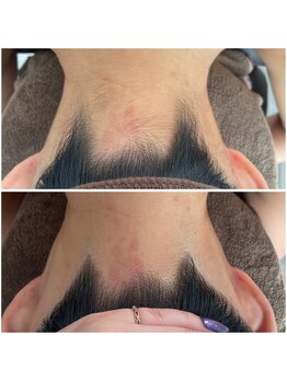 ミース 北九州店/うなじ○ビフォーアフター