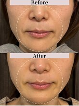 ヴィタベラ(Vita Bella)&nbsp;たるみ スッキリ！