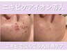 ニキビで悩んでる人専用コース