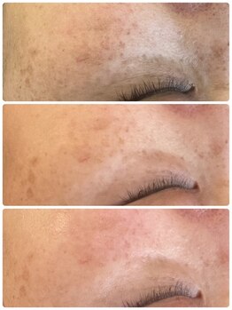 イノエ(inoe)/【もやもやシミも得意です】